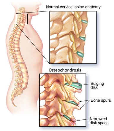 cervikálna osteochondróza