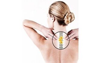 cervikálna osteochondróza u ženy