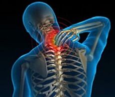 osteochondróza krčnej chrbtice